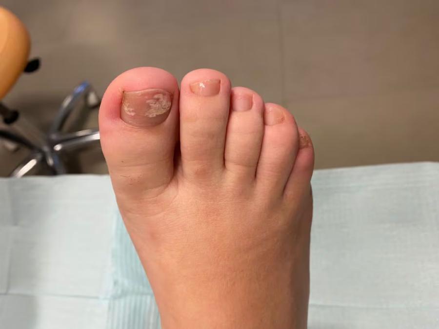 Las uñas frágiles y quebradizas son un síntoma de psoriasis