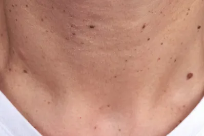 Verrugas en el cuello: por qué aparecen y cómo podemos tratarlas