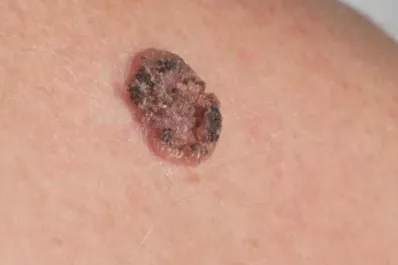 Cuál es el tipo más común de cáncer de piel y cómo tratarlo