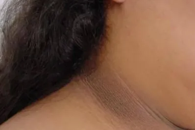 Manchas oscuras en el cuello, axilas o entrepierna: qué las causa y cómo tratarlas