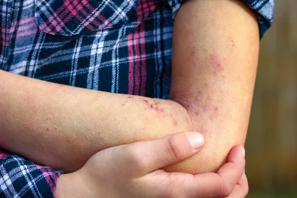 Día Mundial del Lupus: ¿cuáles son los síntomas de esta enfermedad frecuente en el mundo?