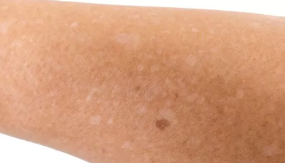 ¿Por qué salen manchas blancas en la piel?