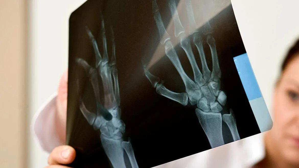 El término “cáncer de hueso” no incluye aquellos que se originan en otra parte del cuerpo y se propagan hacia la estructura ósea.