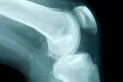 Cuáles son los primeros síntomas del cáncer de huesos y qué lo puede provocar