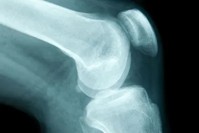 Cuáles son los primeros síntomas del cáncer de huesos y qué lo puede provocar