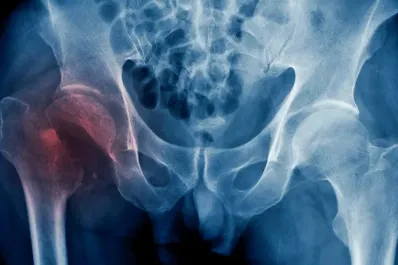 Osteoporosis: estas son las partes del cuerpo que más riesgo tienen de fracturarse