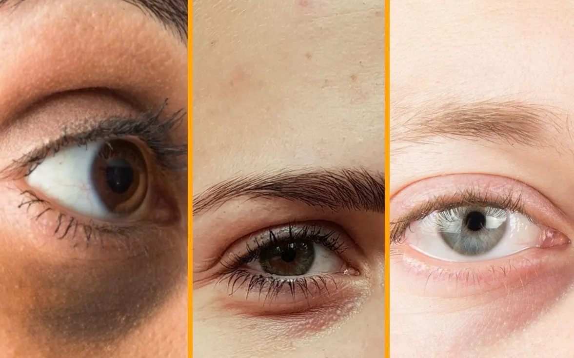 Las ojeras también nos pueden indicar alguna enfermedad que no reviste gravedad