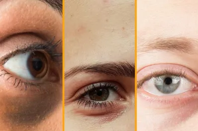 Síntomas: ¿sabías que las ojeras pueden indicar enfermedades?