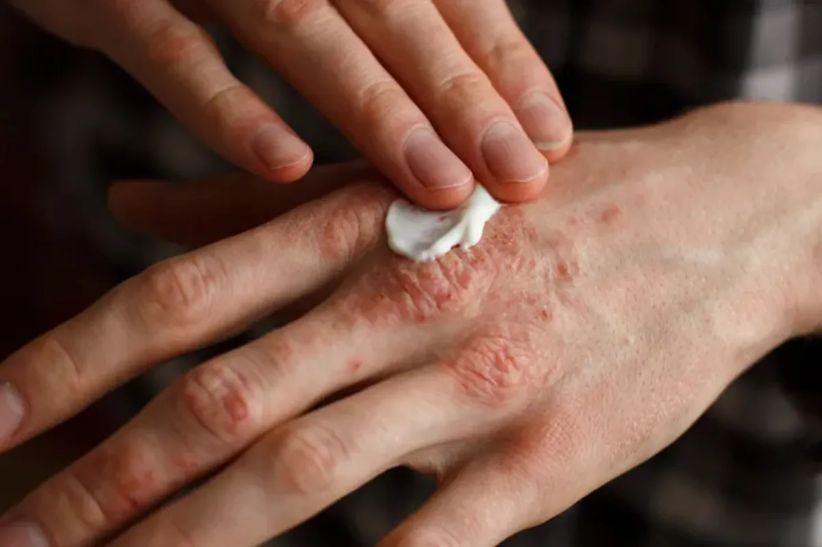 Psoriasis pustulosa generalizada: qué es y cuáles son los síntomas