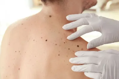 ¿Cómo saber si tengo un melanoma? Cinco síntomas a los que debes estar atento