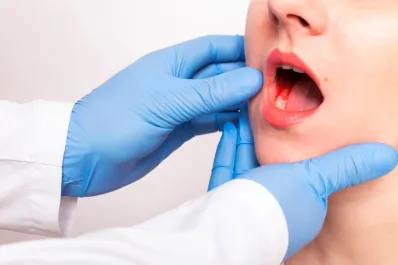Cáncer de boca: ¿cuáles son sus principales factores de riesgo y cómo hacerse un autoexamen?