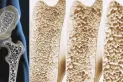 Cuál es la proteína que podría fortalecer los huesos y prevenir la osteoporosis