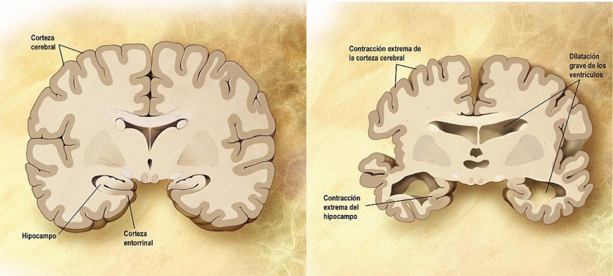 ¿Cuáles son las causas del alzheimer?