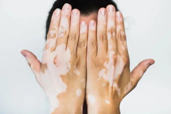 Día Mundial del Vitiligo: a quiénes afecta y cuáles son sus síntomas