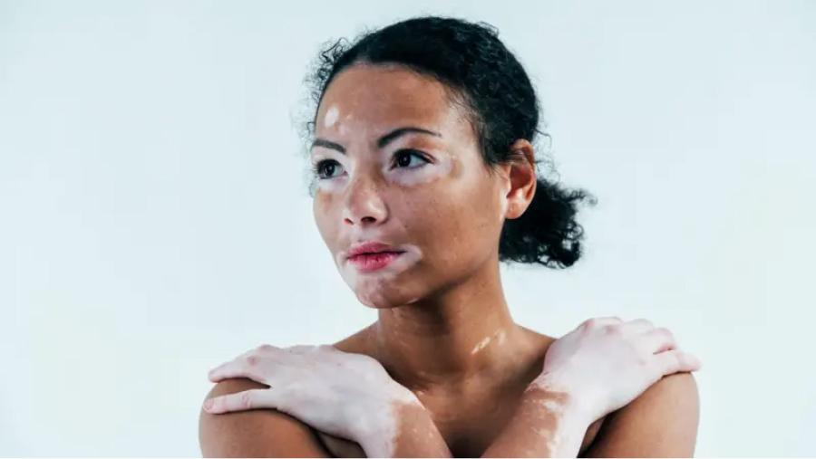 Día Mundial del Vitiligo: a quiénes afecta y cuáles son sus síntomas