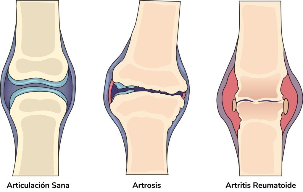En la artrosis el cartílago que recubre las articulaciones se desgasta.