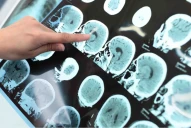 La FDA aprobó un fármaco que retrasa el avance del alzheimer: cómo funciona y quiénes pueden tomarlo