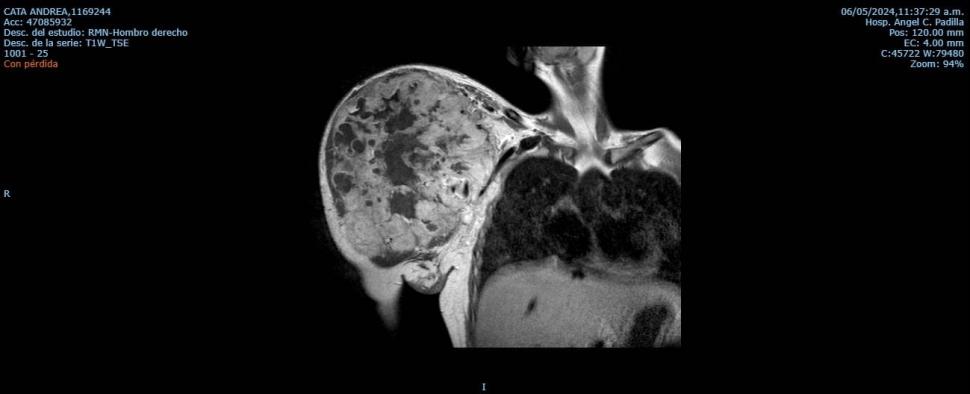 ANTES Y DESPUES. Las radiografías muestran cómo quedó el hombro de Andrea.