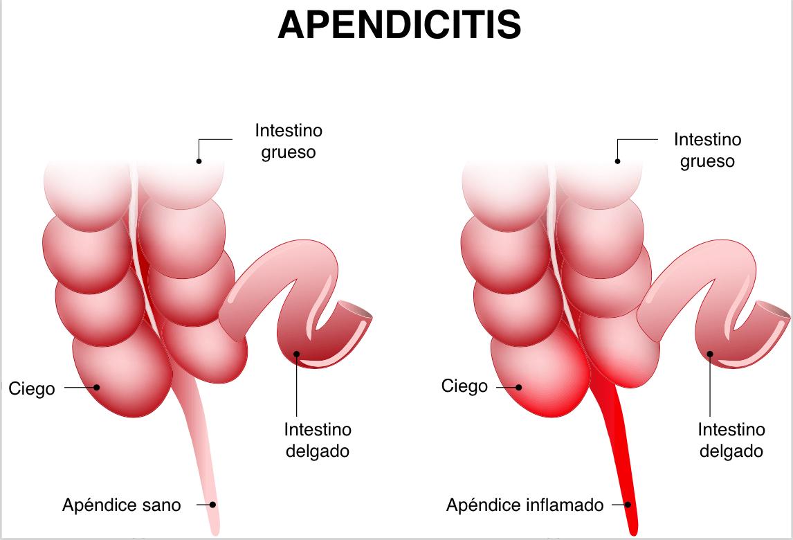 El apéndice está unido a la primera parte del intestino grueso.
