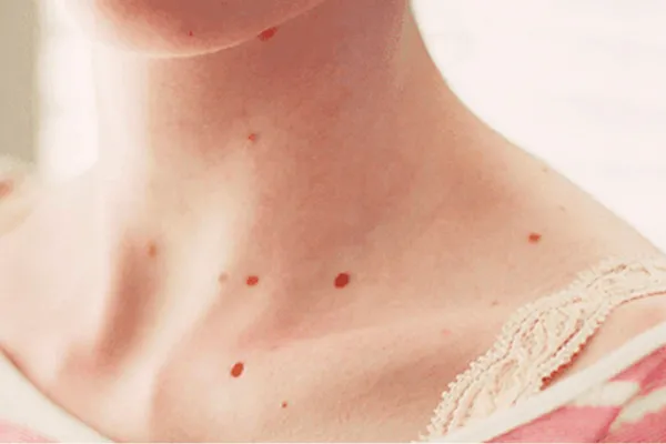Angiomas rubí: ¿qué son los lunares rojos y cuándo preocuparse?