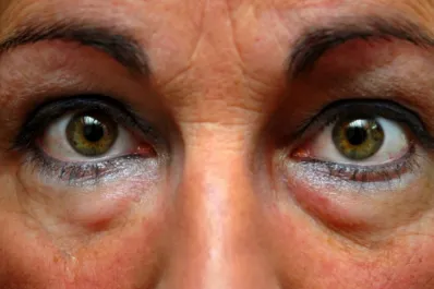 ¿Cuáles son las enfermedades que producen bolsas debajo de los ojos?