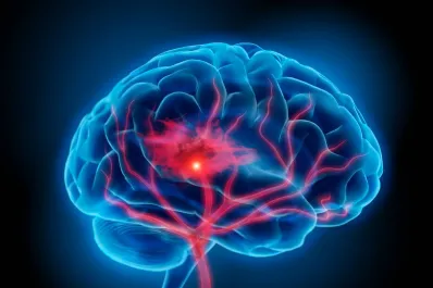 El estrés, una de las primeras causas de la embolia cerebral ¿cómo influye este estado emocional en nuestra salud?