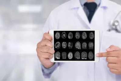 ¿A qué edad puede aparecer el alzheimer?: los síntomas que no se deben pasar por alto