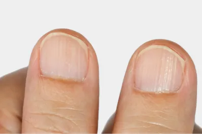 ¿Qué enfermedades pueden significar las uñas rayadas?
