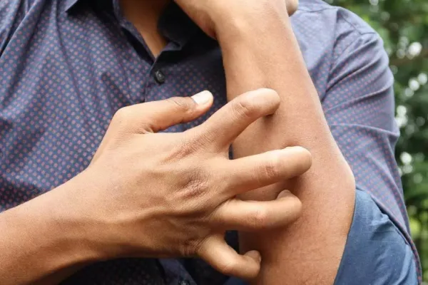 El cáncer de piel que no parece cáncer: claves para detectar la micosis fungoide