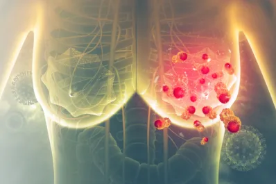 ¿Cómo empieza el cáncer de mama? Estos son los primeros síntomas que aparecen y debes conocer