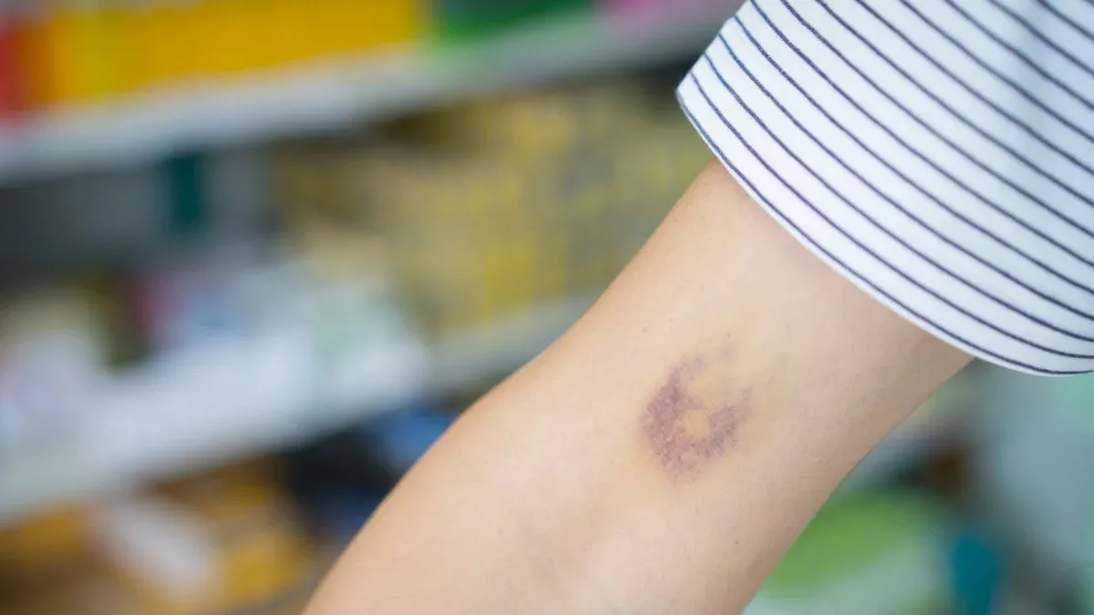 ¿Por qué me salen moretones sin haberme golpeado?