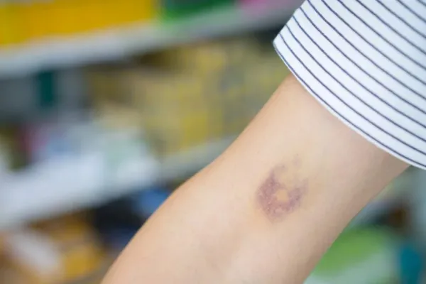 ¿Por qué me salen moretones sin haberme golpeado? La explicación de los especialistas