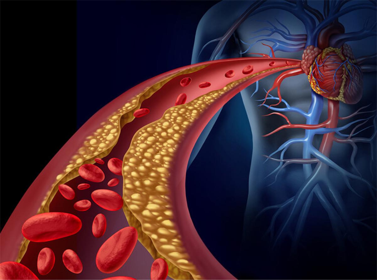 ¿Qué es el colesterol en sangre?