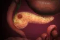 Cáncer de páncreas: estas son las personas con mayor riesgo de padecer esta enfermedad