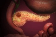 Cáncer de páncreas: estas son las personas con mayor riesgo de padecerlo