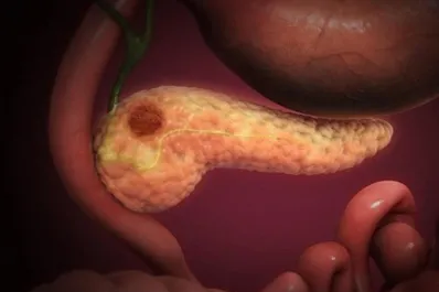 Cáncer de páncreas: estas son las personas con mayor riesgo de padecerlo