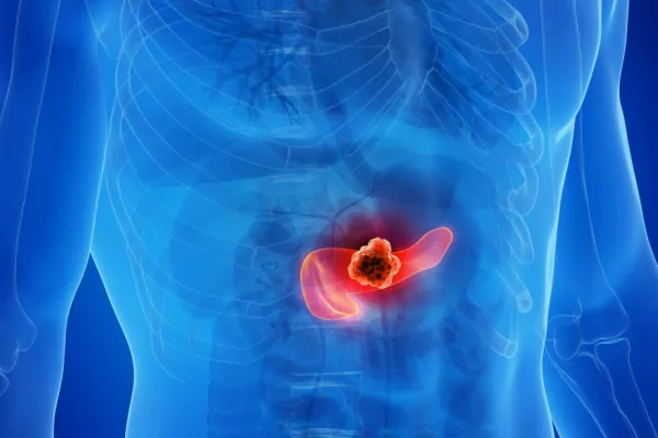 Cáncer de páncreas: por qué es uno de los más difíciles de detectar y a qué señales estar alertas
