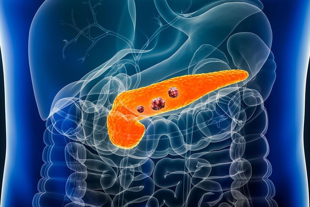 Los altos niveles de insulina pueden provocar cáncer de páncreas.