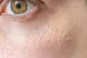 ¿Por qué aparecen puntitos blancos en tu piel? Conocé cómo eliminarlos