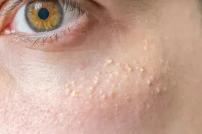 ¿Por qué aparecen puntitos blancos en tu piel? Conocé cómo eliminarlos