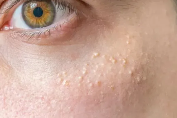¿Por qué aparecen puntitos blancos en tu piel? Conocé cómo eliminarlos