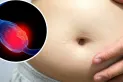 ¿Cómo saber si tienes cáncer de ovario? Poné atención a estos síntomas