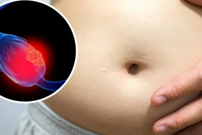 ¿Cómo saber si tienes cáncer de ovario? Poné atención a estos síntomas