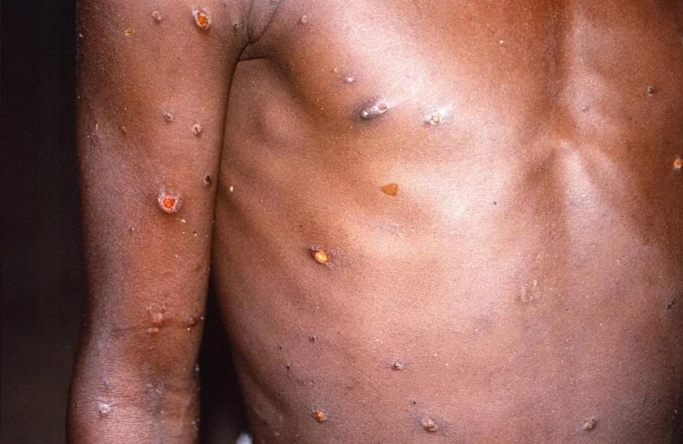 Suecia reporta el primer caso de mpox en Europa