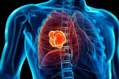 El hábito más peligroso que fumar: conocé la combinación que multiplica el riesgo de cáncer de pulmón