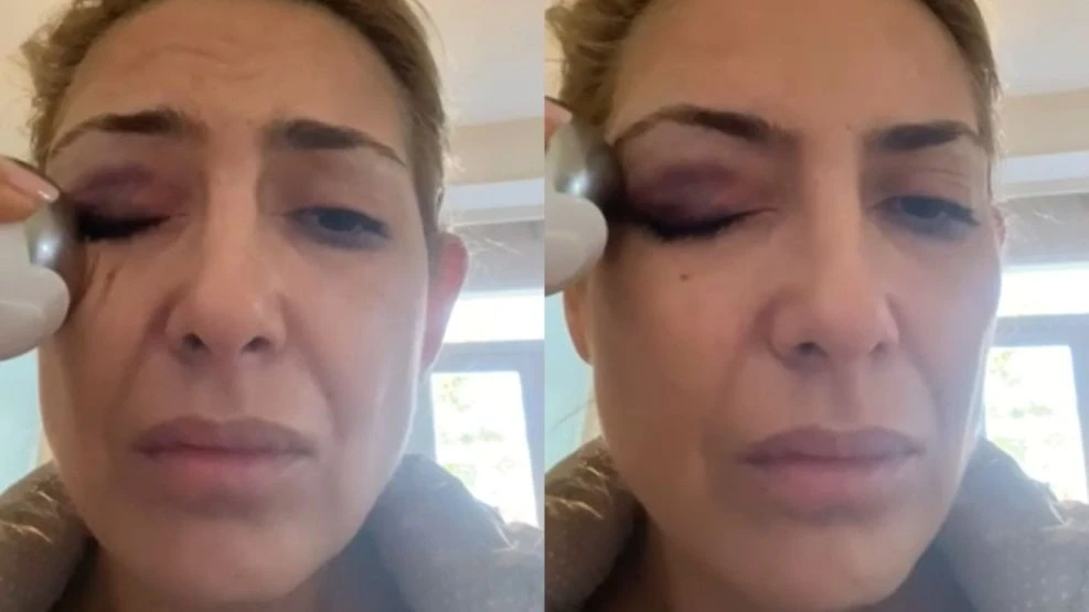 IMPACTANTE. Así quedó el rostro de Fabiola debido a los golpes, según se pudo ver en un nuevo video. imagen de video