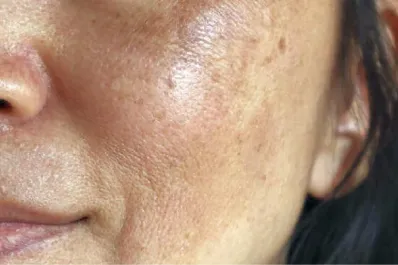 ¿Cómo utilzar el aceite de oliva para quitar las manchas de la cara?