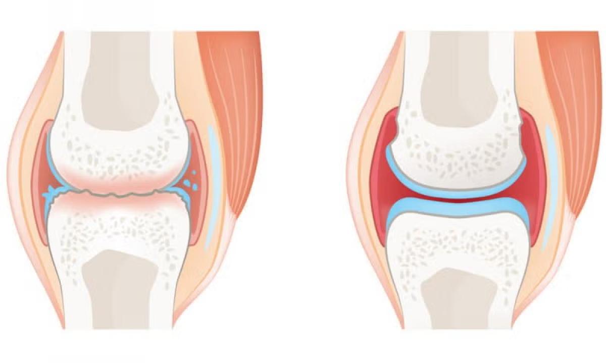 ¿Qué es la osteoartritis?