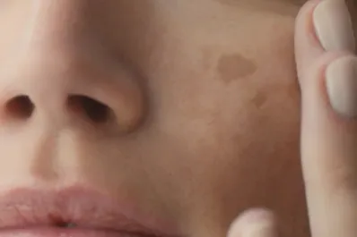 Manchas oscuras en la cara y el cuerpo: por qué se forman y cómo prevenirlas