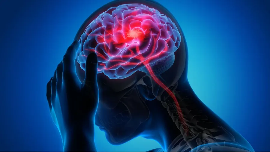 El accidente cerebrovascular es la segunda causa de muerte en el mundo